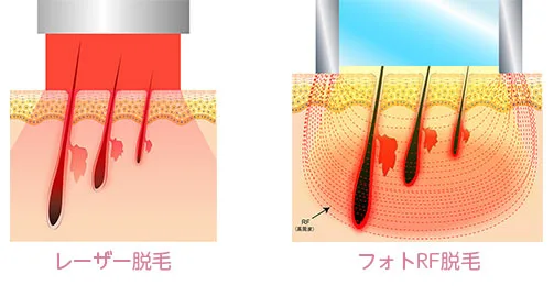 フォトRF脱毛（DSL） | 高橋医院